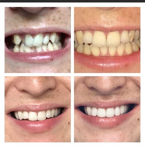 teeth straightening orthodontics tooth alignment swindon