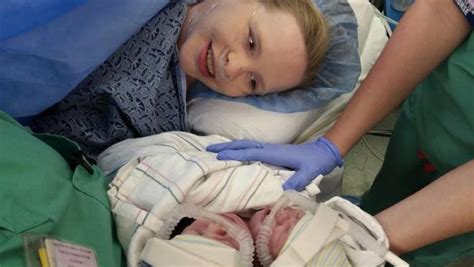 conjoined twins born in atlanta pass away