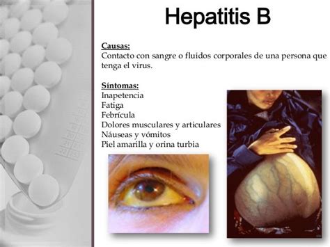 Clamidia Hepatitis B Y C [enfermedades De Transmisión Sexual]