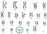 Karyotype Syndrome Down sketch template