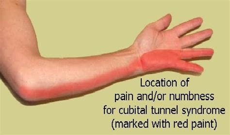 Ulnar Nerve Compression Cawley Physical Therapy