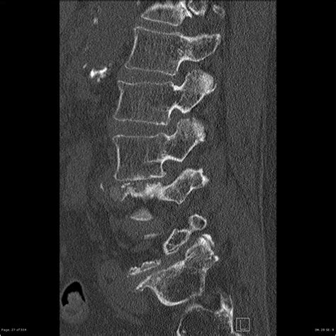 Xlif Subsidence Radiology Case