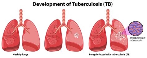 chart showing development  tuberculosis  vector art  vecteezy