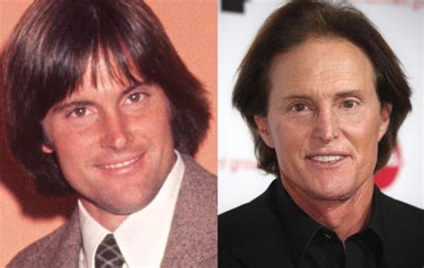 bruce jenner plastic surgery before and after facelift photos famous