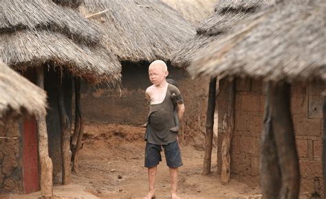 attacks on people with albinism in africa european