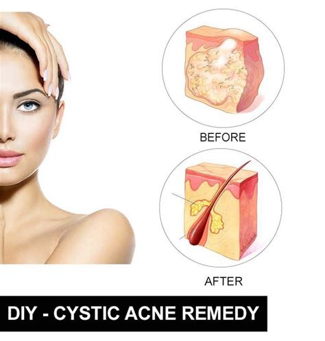 diy cystic acne treatment 11 anti inflammatory diy acne remedies to