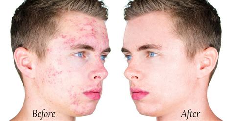 why acne after facial sex photo