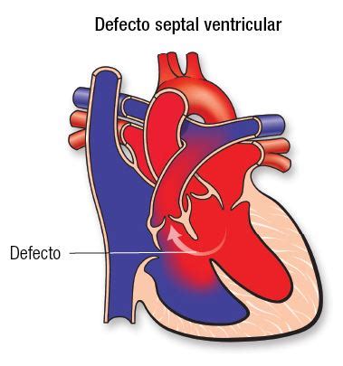 defectos del tabique ventricular sintomas  tratamiento