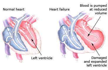 sided heart failure condition  treatment airphysio