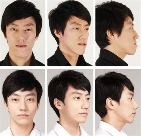 Before And After Photos Of Korean Plastic Surgery 30 Pics