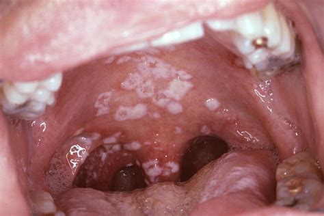 oral thrush on the roof of the mouth here s how to treat it