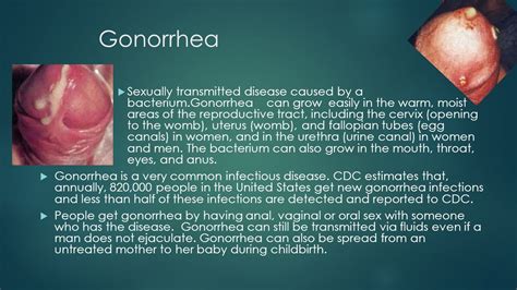 What Does Gonorrhea Look Like Public Health