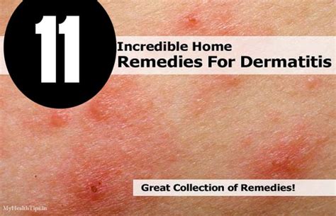 home remedies  dermatitis dorothee padraig south west skin health care
