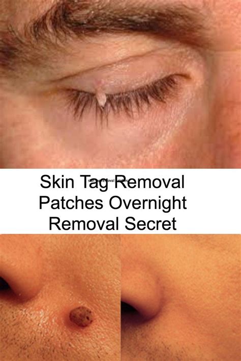 how do you remove a skin tag on eyelid howtormeov