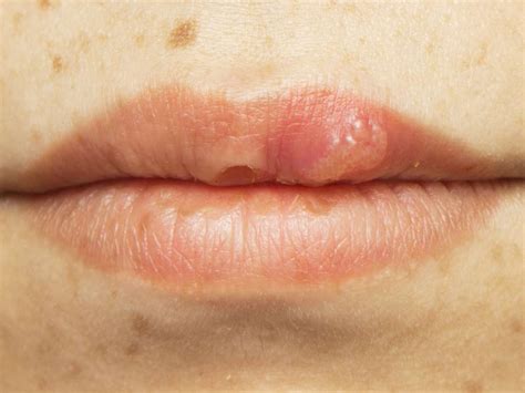 hiv mouth sores pictures causes treatment and prevention