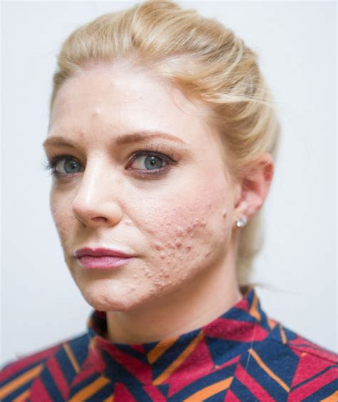 List 92 Pictures Acne Scars On Face Pictures Stunning