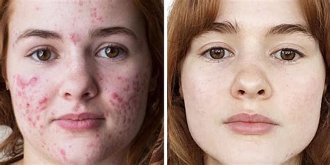 The Best Accutane Before And After Results Kali Kushner