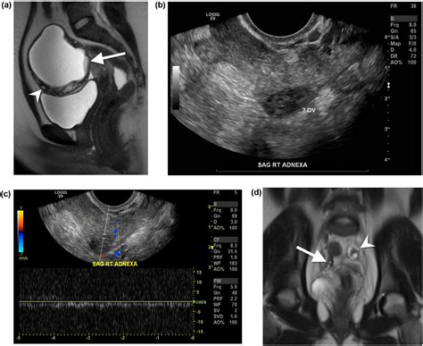 mri  ovarian torsion correlation  imaging features   presence  perifollicular