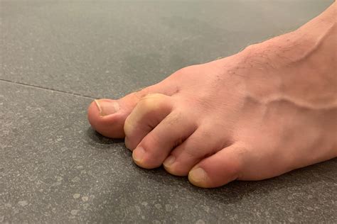 claw toes orthotics  melbourne