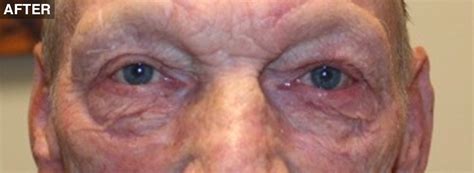 direct brow bleph mmcr ba after 1 northwest eyelid