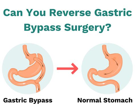 gastric bypass reversal     reversed
