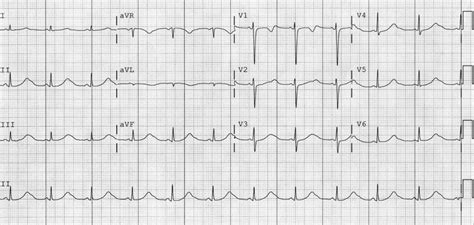 ecg long qt syndrome showing prolonged   intervals  heartbeats acls kidney disease