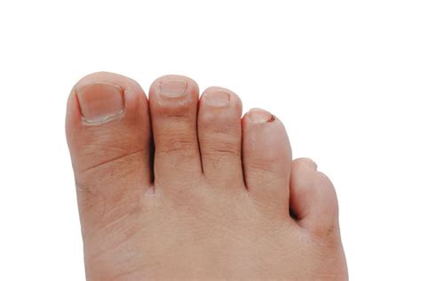 partial nail avulsion  ingrown toenail trevor lane podiatry
