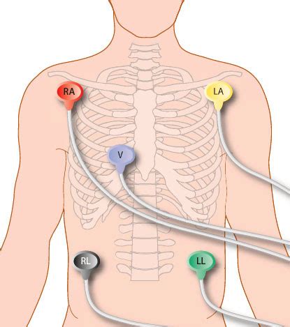 ecg monitor lead placement