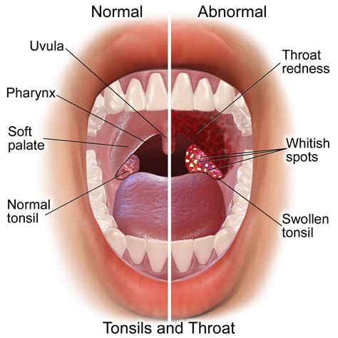 strep throat  sore throat  treatments preventions