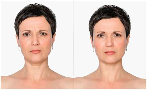 chirurgie esthétique paupières blepharoplastie lipectomie à agen