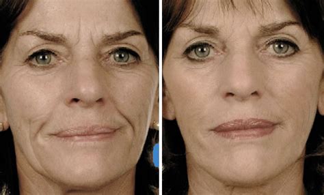 facial injectable fillers