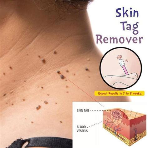 chinese medicine treatment skin warts removal foot corn