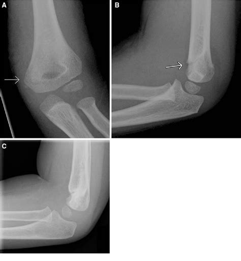 Figure 4 From Pediatric Supracondylar Fractures Of The