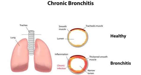 chronic bronchitis chronic bronchitis articles chronic