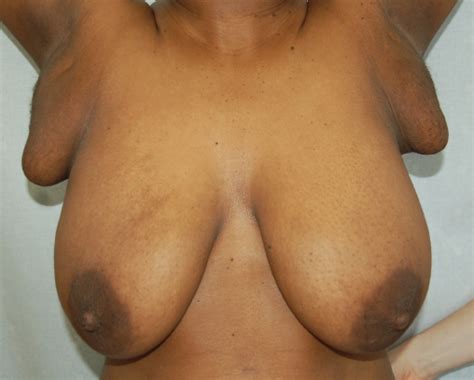 polymastia breast mega porn pics