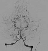 Cerebral Angiography Angiogram Posterior Wikipedia Circulation Projection Showing Vessel sketch template