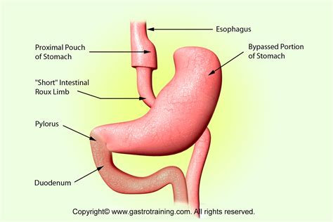 Source Gi Surgery Bariatric