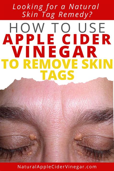 how to use apple cider vinegar to remove skin tags in 2020 skin tags