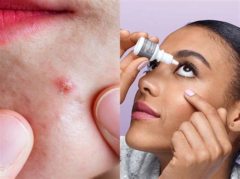 people love  viral hack   eye drops  conceal acne   dermatologist