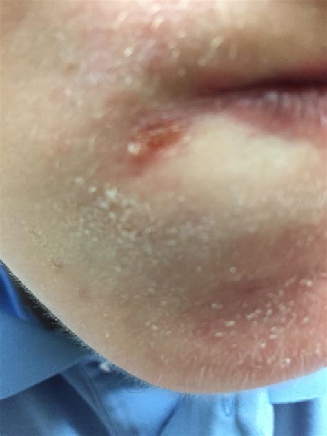 white bumps  turn  pimples general acne discussion