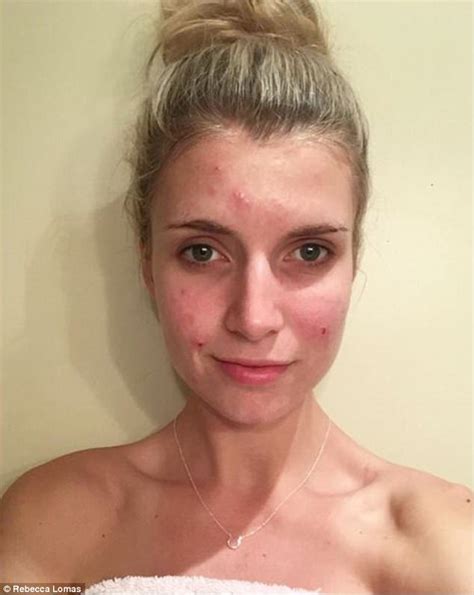 Blogger Beck Lomas Shares Pictures Of Her Bleeding Pimply Face To Be