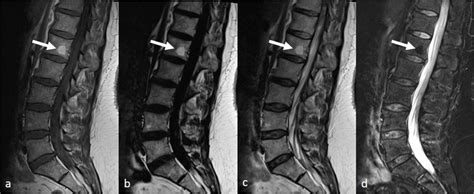 Lumbar Spine Mri In A 41 Year Old Female Including T1