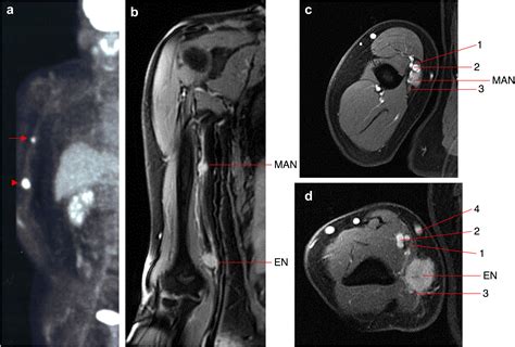 mid arm lymph nodes dissection  melanoma journal  plastic