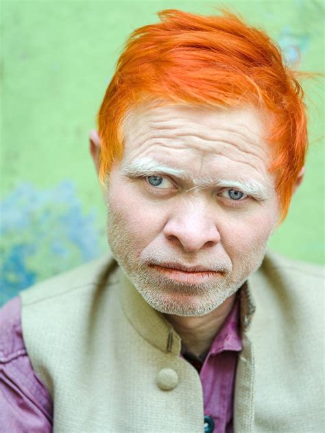 An Albino In India Photo By Gerry Huber Interestingasfuck