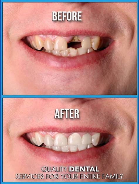 dental implants pictures     dental implants