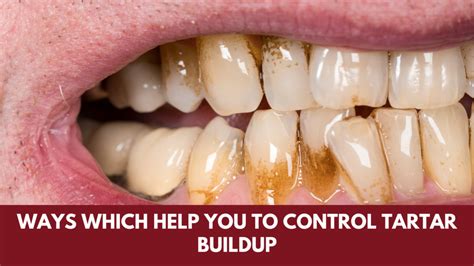 ways which help you to control tartar buildup