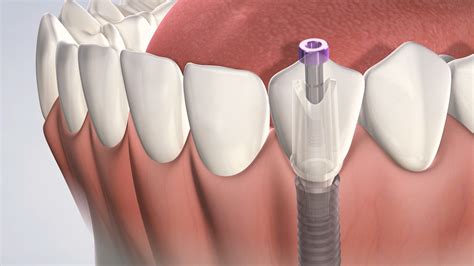 post operative instructions  dental implant surgery  oral