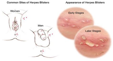 Best Way To Prevent Herpes Outbreaks Happen