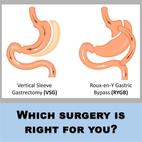 Gastric Bypass Vs Gastric Sleeve Surgery Which Weight