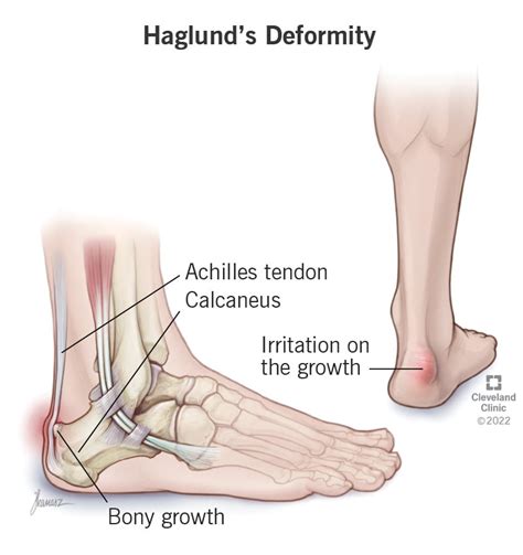 haglunds deformity  symptoms treatment
